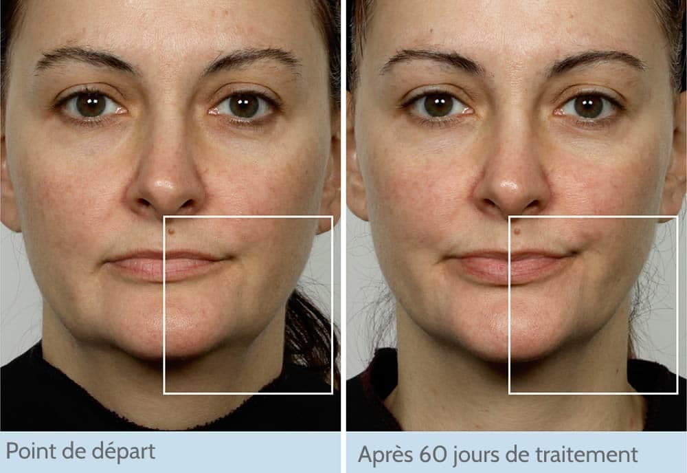 NuFACE via Amazon