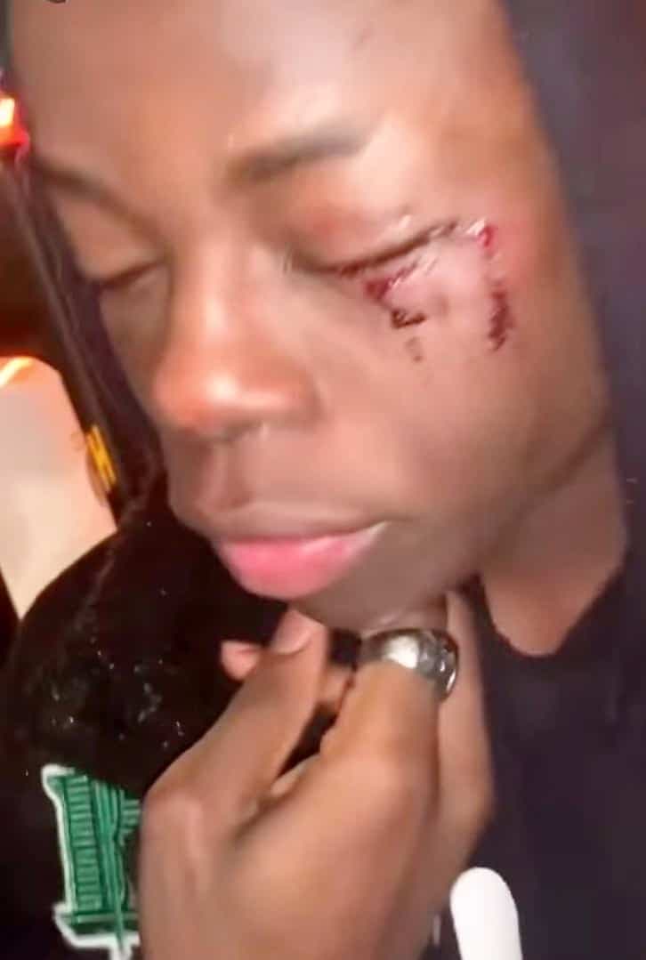 Pacifique Niyokwizera montrant ses blessures après l’arrestation.