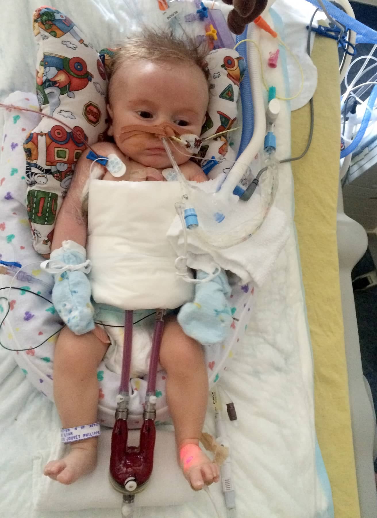 Liam avait dû être branché à un cœur de Berlin pour survivre jusqu’à sa greffe de cœur. Il a été le plus petit patient cardiaque du CHU Sainte-Justine.