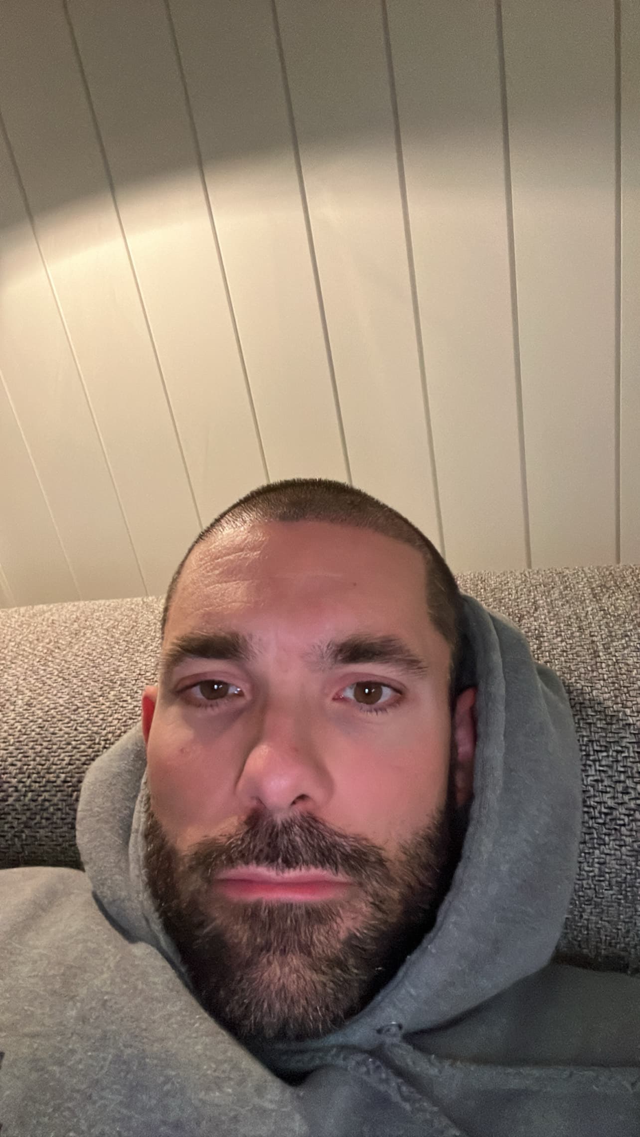 Félix Daigle quelques jours après sa greffe de cheveux.
